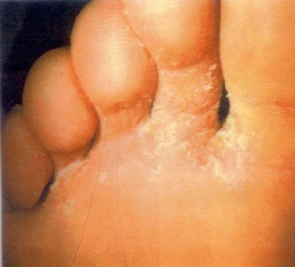 How to Prevent and Treat Athlete's Foot - FASA