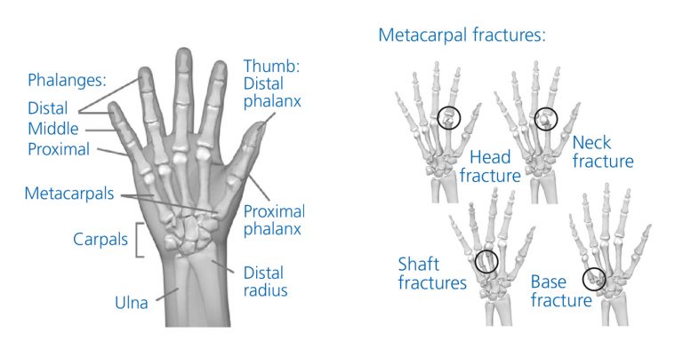 Advice And Exercises Following A Metacarpal Fracture - South Tees ...