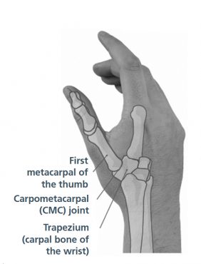 Osteoarthritis of the carpometacarpal thumb joint - South Tees ...