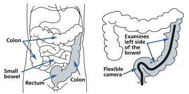 Flexible sigmoidoscopy - South Tees Hospitals NHS Foundation Trust