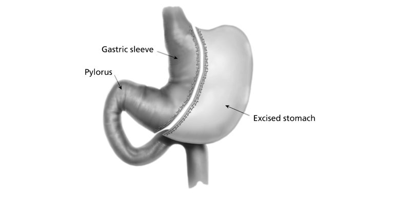 Laparoscopic sleeve gastrectomy - South Tees Hospitals NHS Foundation Trust