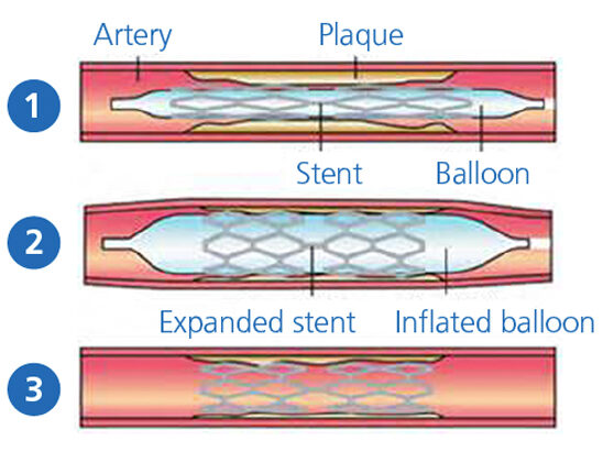 Coronary angiography - South Tees Hospitals NHS Foundation Trust