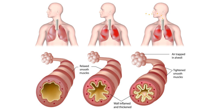 Asthma guidance and information - South Tees Hospitals NHS Foundation Trust