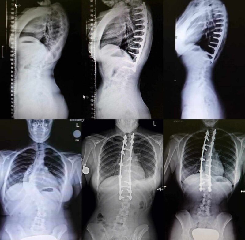 X-ray images of before and after Hannah’s back